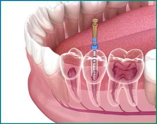 Root Canal Treatment Blog